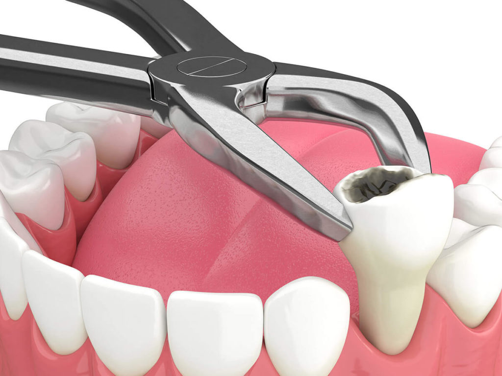 tooth extraction visual