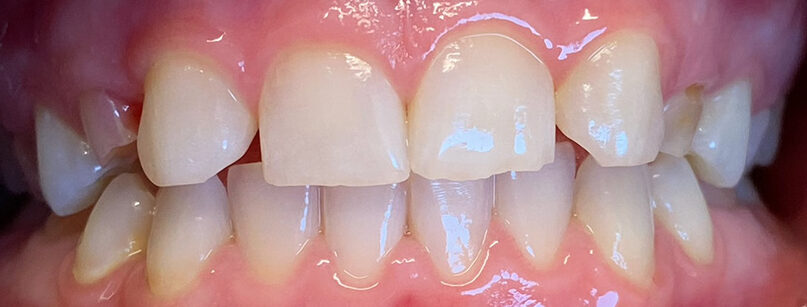 dental crowns and bridges before