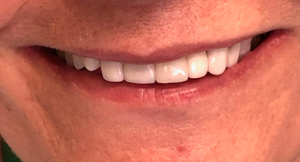 dental implants afterwards
