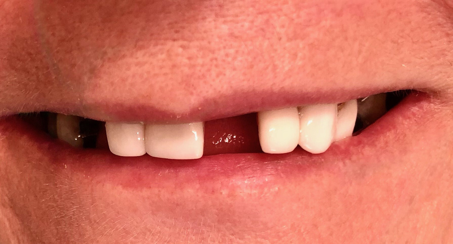 Dental Implants Shreveport, LA Shreveport Dental Solutions