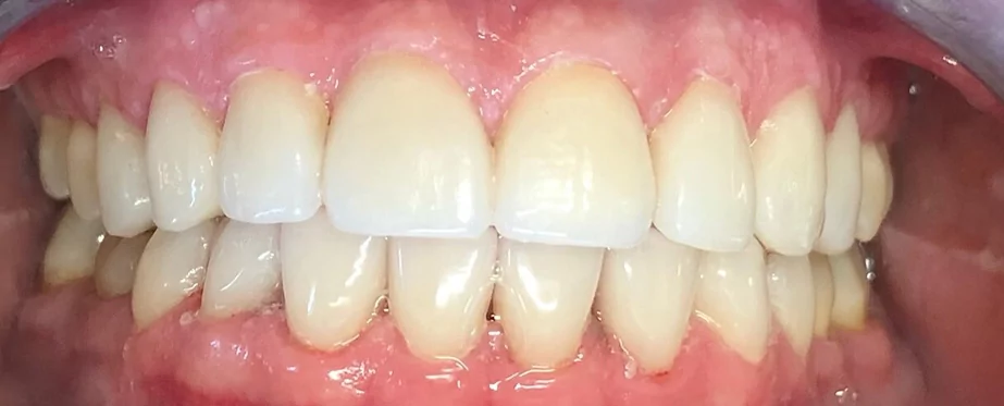 dental veneers after