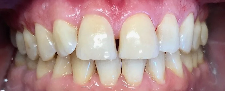 dental veneers before