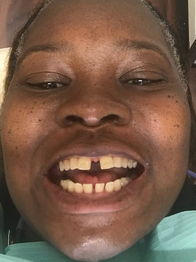 woman before dental veneers