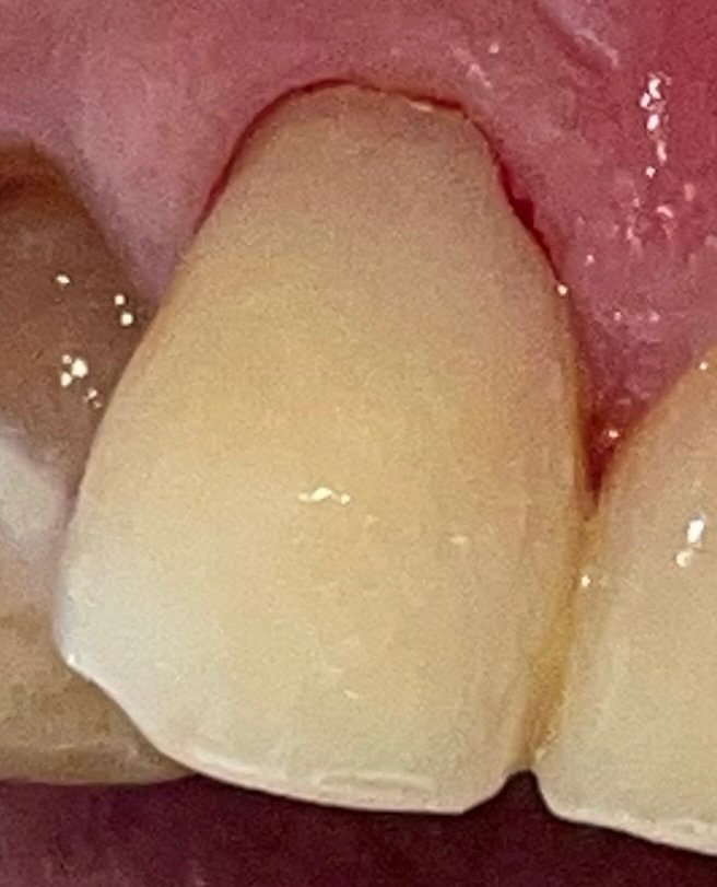 After a tooth filling at Shreveport Dental Solutions
