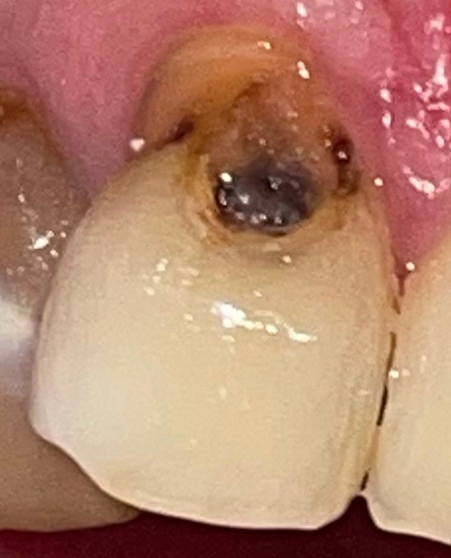 Damaged tooth before a tooth filling at Shreveport Dental Solutions