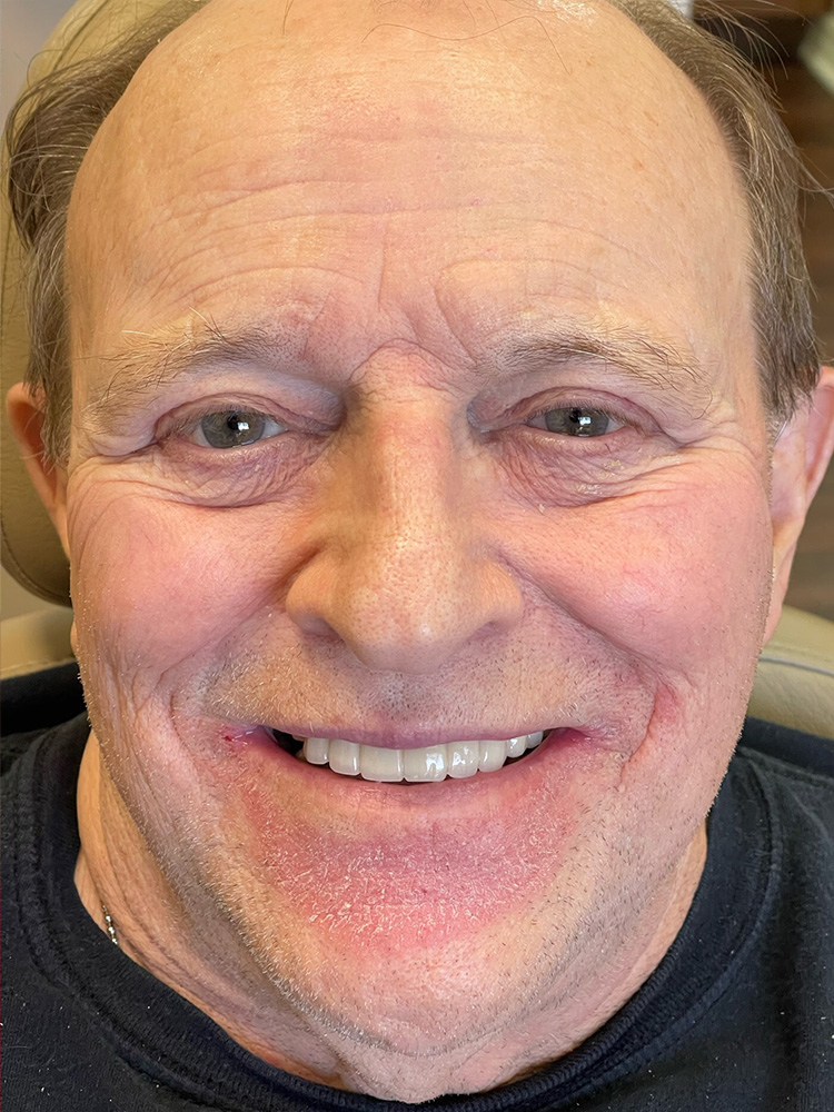 man smiling after dental bridges