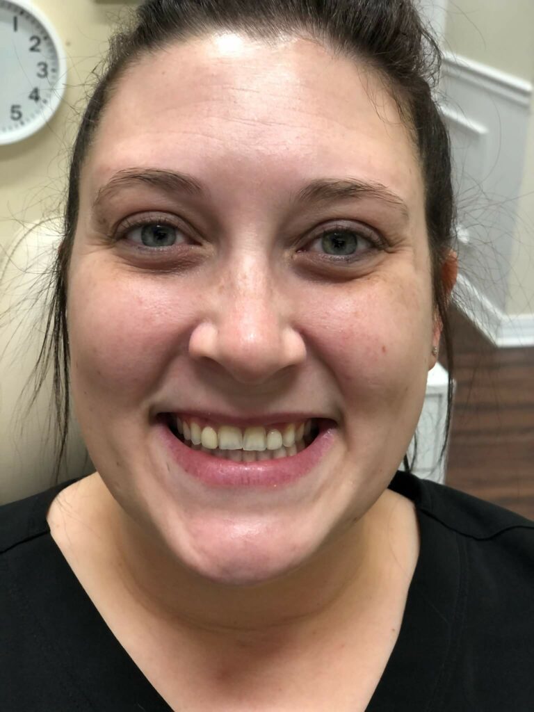 patient smiling before dental bridges