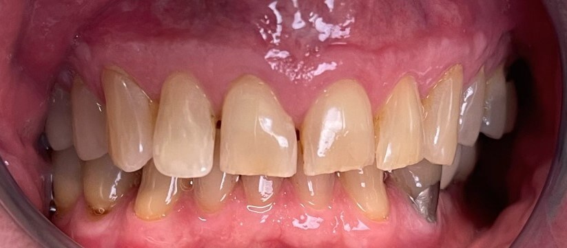 before dental crowns procedure