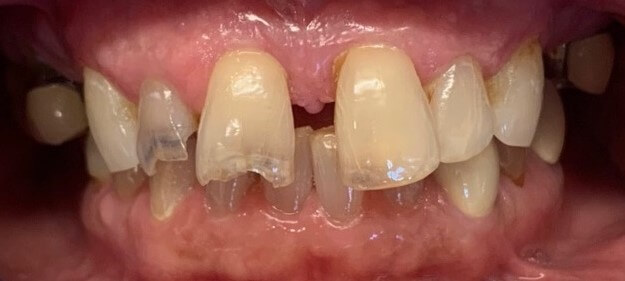 before dental crowns patient