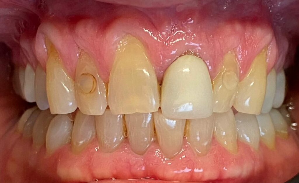 dental crowns patient before smile gallery
