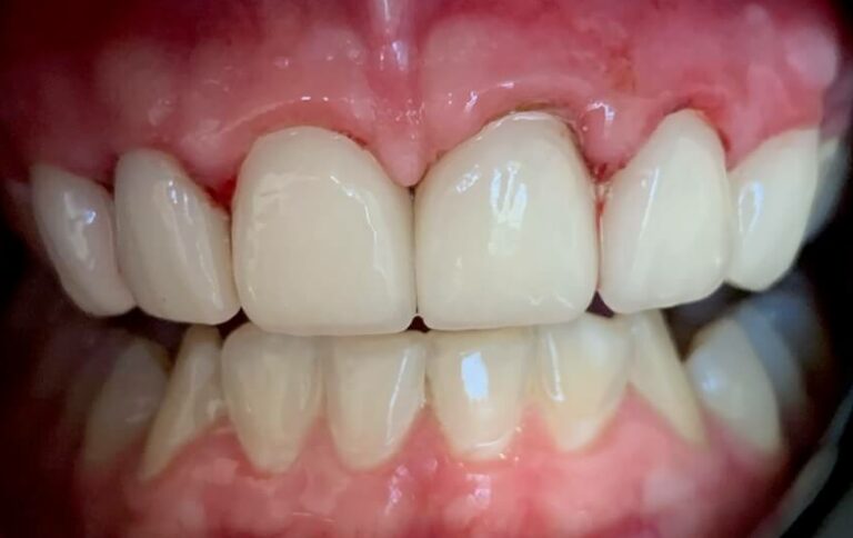 dental crowns patient after
