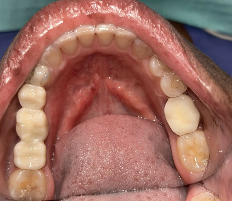 dental implants after smile gallery