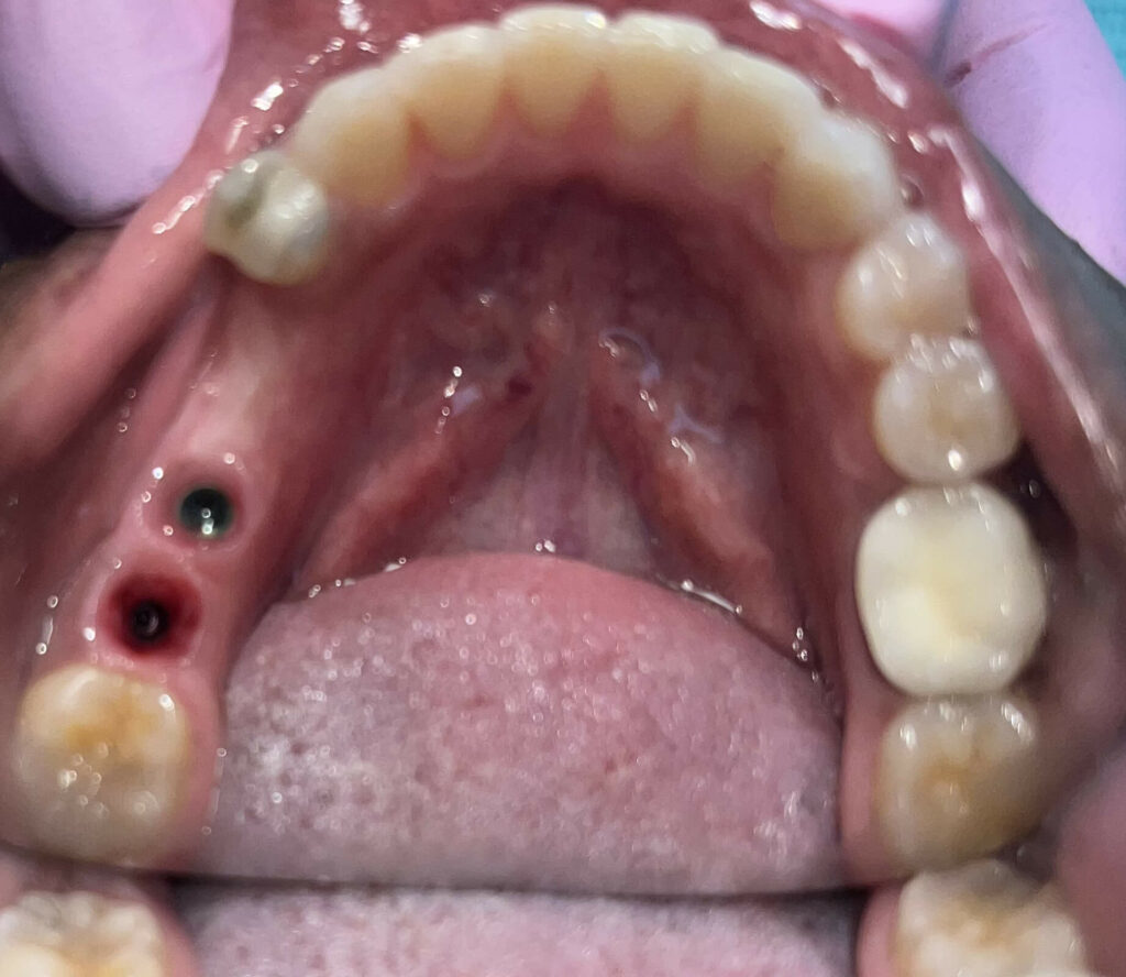 dental implants person missing multiple teeth