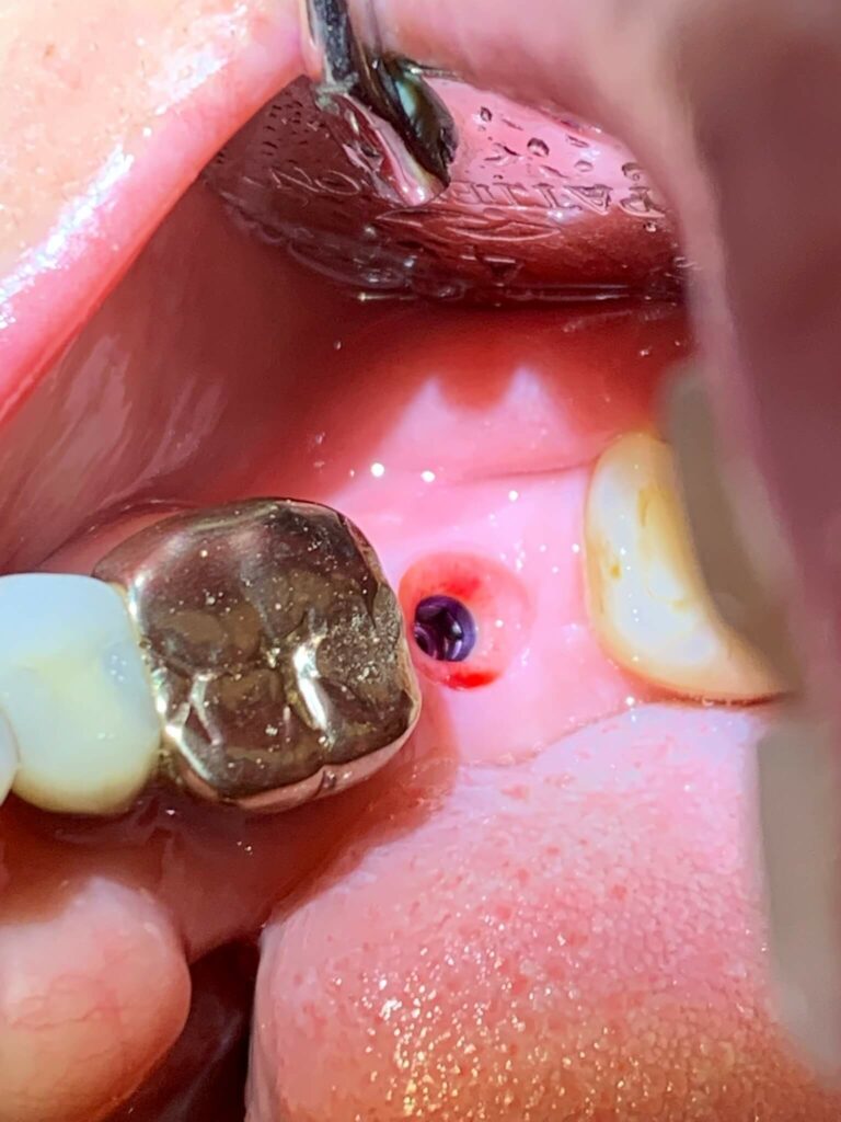 close close up of dental crown next to hole