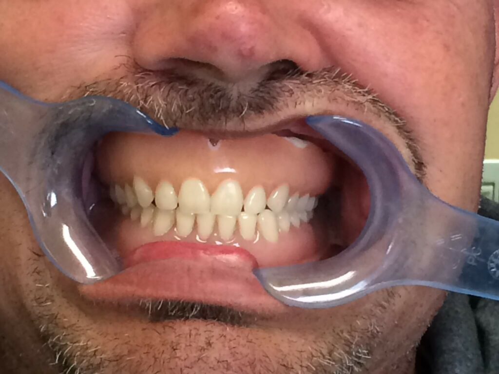 dental implant smile gallery photo