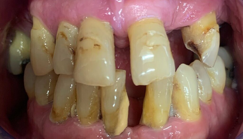 dental implants before photo