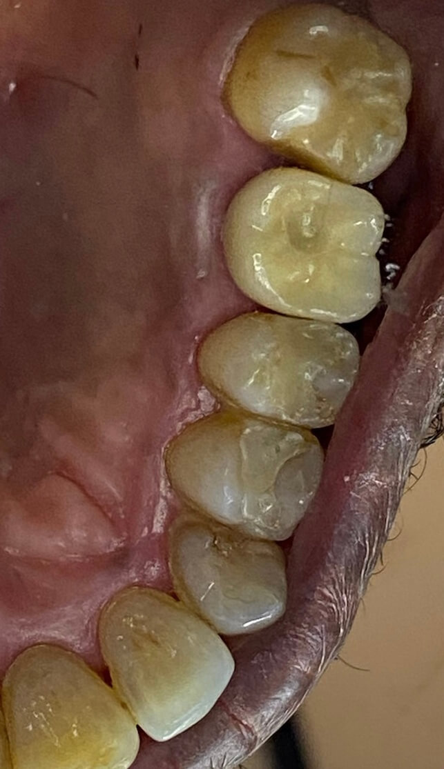 dental implants before photo