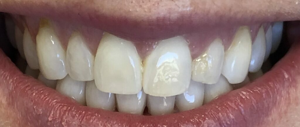 dental veneers on patient