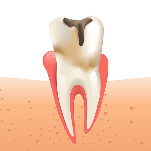 drawing of a tooth showing decay