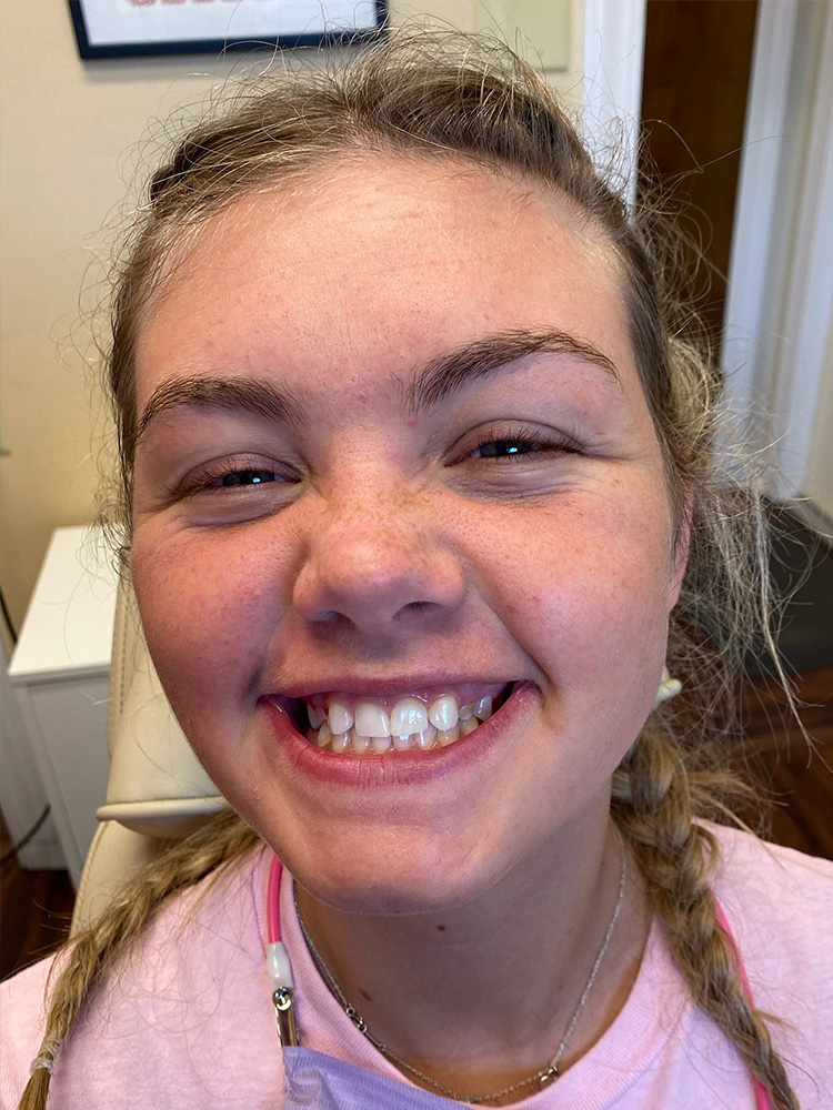 Dental Bridges in Shreveport, LA at Shreveport Dental Solutions