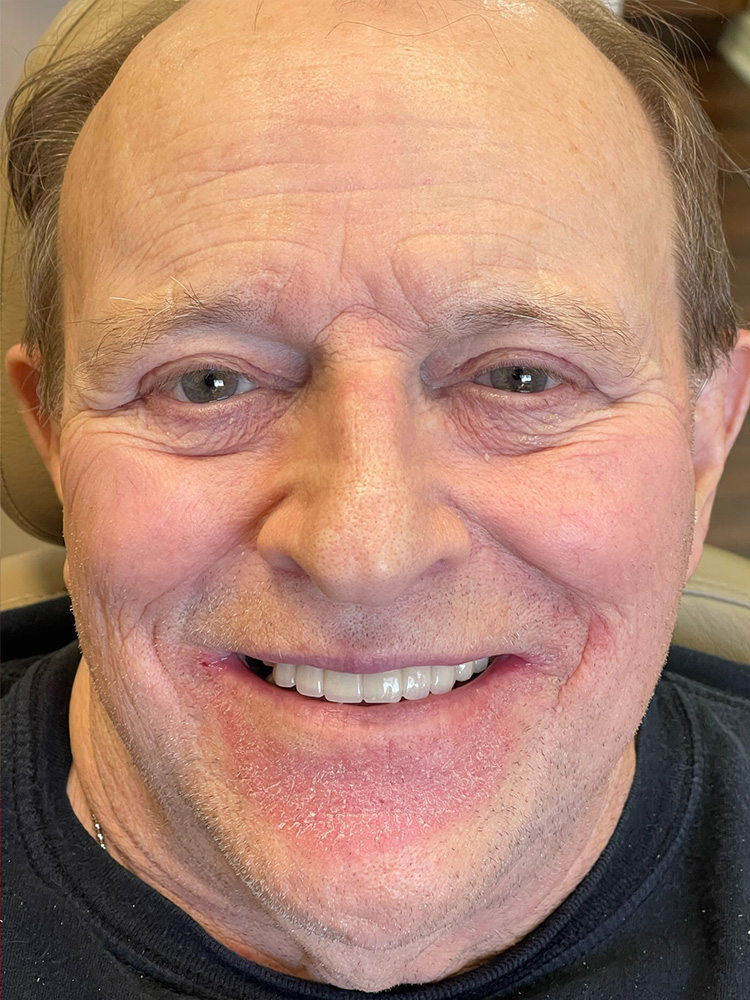 Dental Bridges in Shreveport, LA at Shreveport Dental Solutions