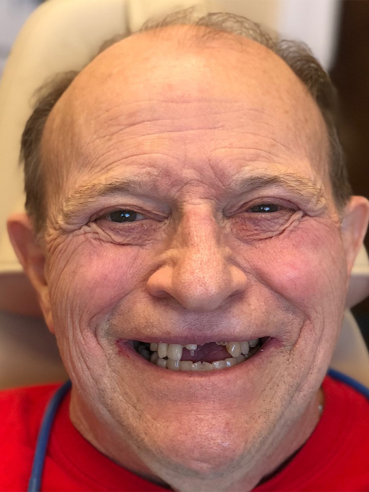 Dental Bridges in Shreveport, LA at Shreveport Dental Solutions