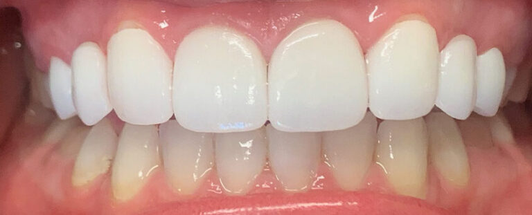 Dental Bridges in Shreveport, LA at Shreveport Dental Solutions