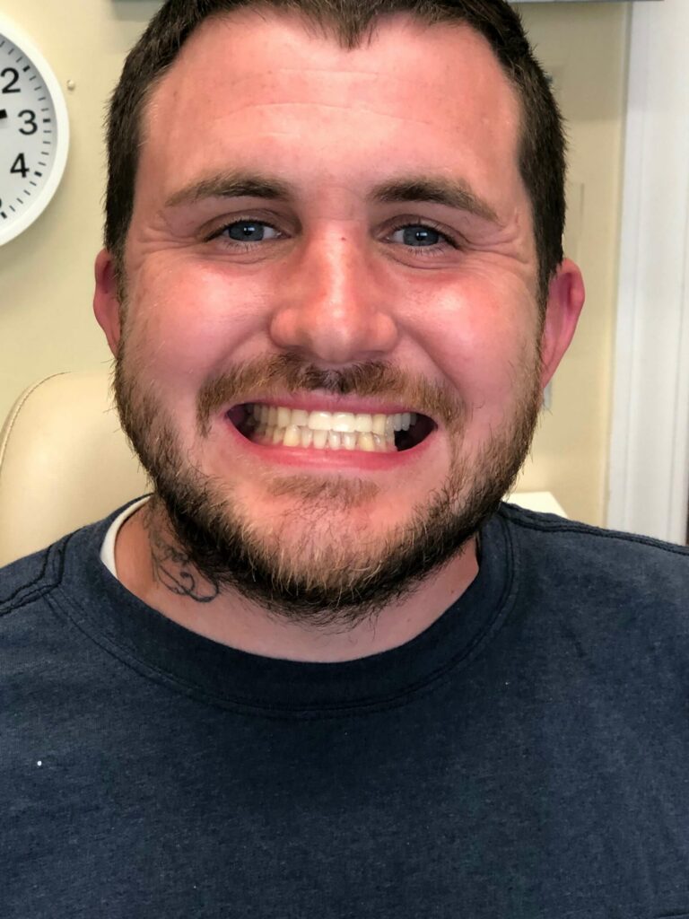 Dental Bridges in Shreveport, LA at Shreveport Dental Solutions