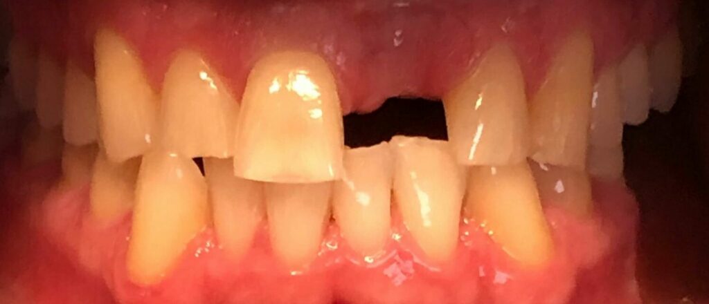 Dental Bridges in Shreveport, LA at Shreveport Dental Solutions