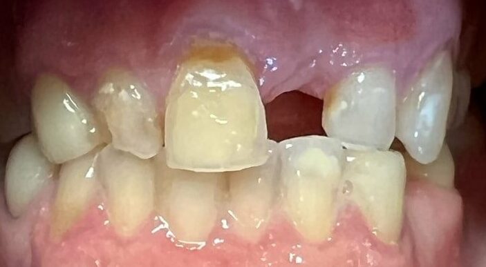 Dental Bridges in Shreveport, LA at Shreveport Dental Solutions
