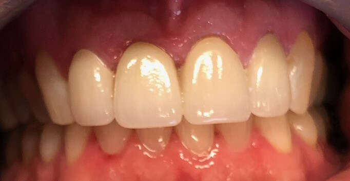 Dental Bridges in Shreveport, LA at Shreveport Dental Solutions