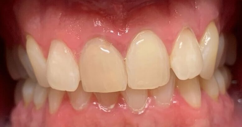 Dental Bridges in Shreveport, LA at Shreveport Dental Solutions