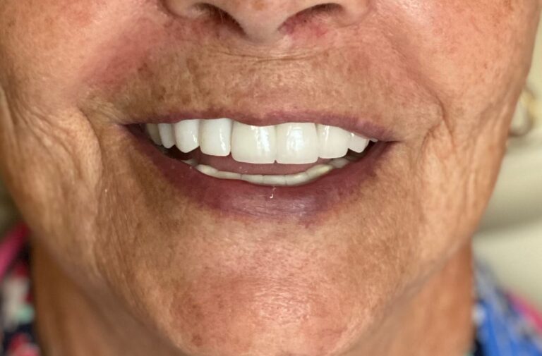Dental Bridges in Shreveport, LA at Shreveport Dental Solutions