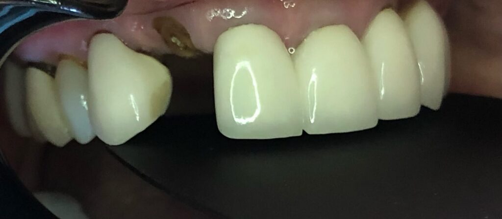 Dental Bridges in Shreveport, LA at Shreveport Dental Solutions