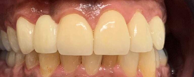 Dental Bridges in Shreveport, LA at Shreveport Dental Solutions