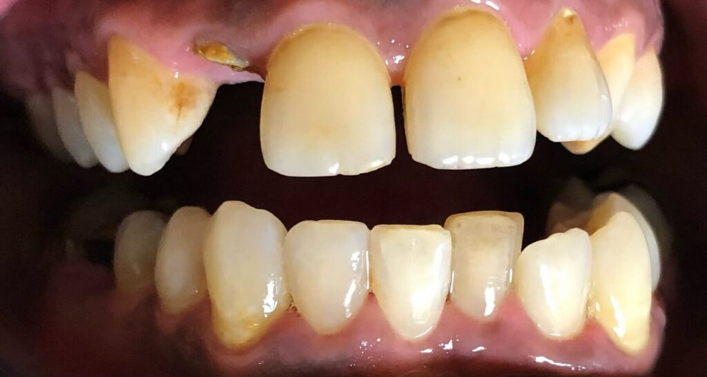 Dental Bridges in Shreveport, LA at Shreveport Dental Solutions