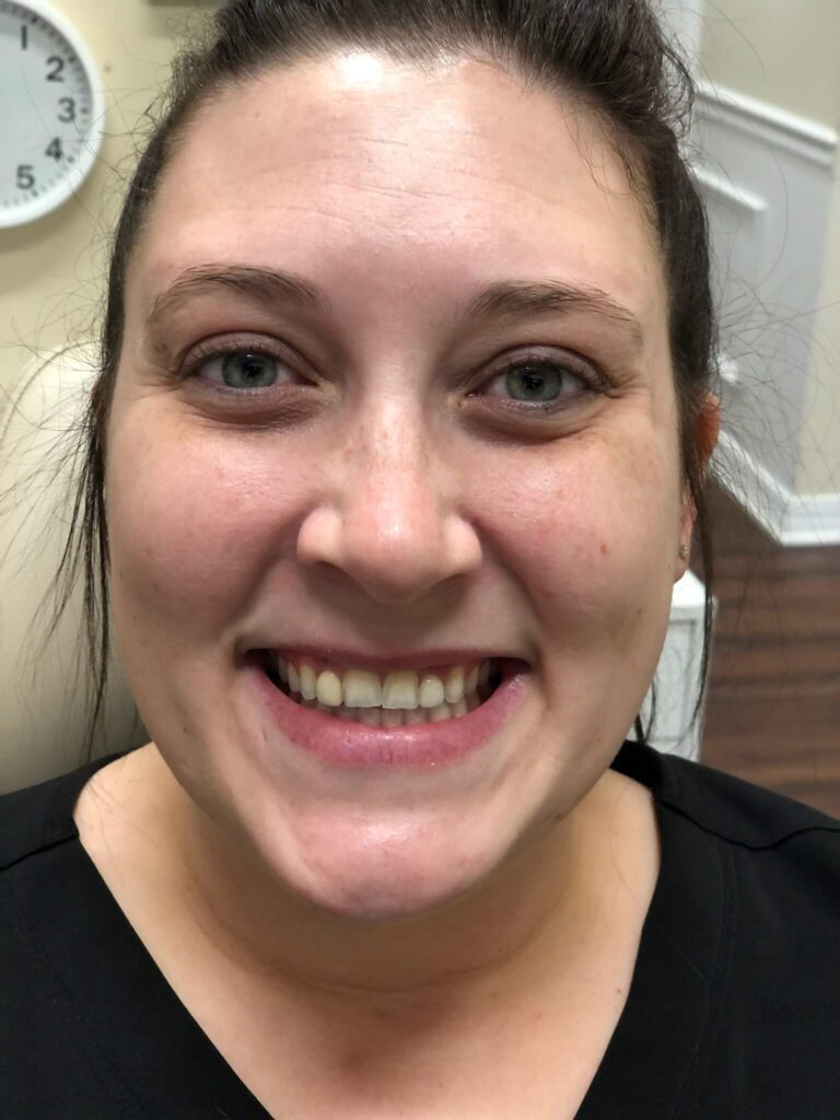 Dental Bridges in Shreveport, LA at Shreveport Dental Solutions
