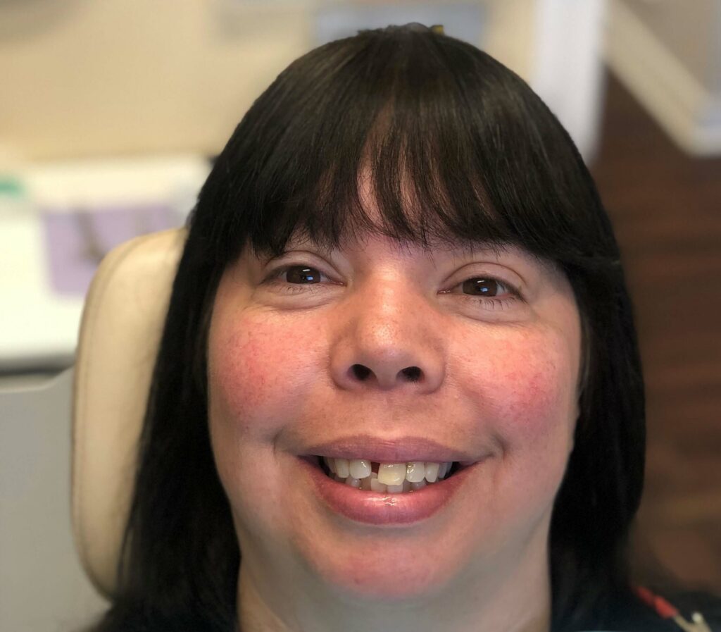 Dental Bridges in Shreveport, LA at Shreveport Dental Solutions