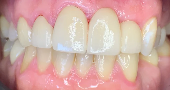 Dental Bridges in Shreveport, LA at Shreveport Dental Solutions