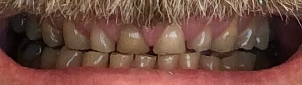 Dental Crown Patient in Shreveport, LA at Shreveport Dental Solutions