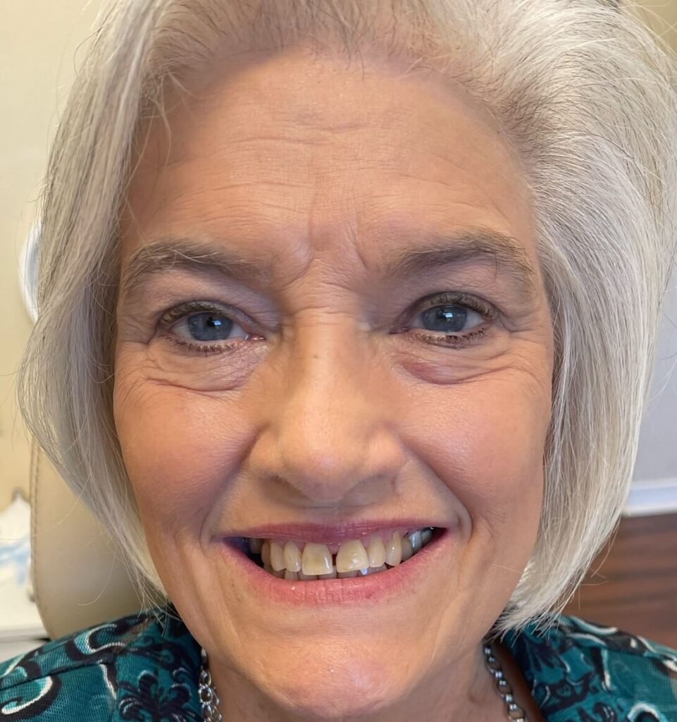 Dental Crown Patient in Shreveport, LA at Shreveport Dental Solutions