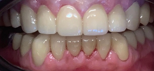 Dental Crown Patient in Shreveport, LA at Shreveport Dental Solutions