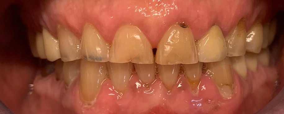 Dental Crown Patient in Shreveport, LA at Shreveport Dental Solutions