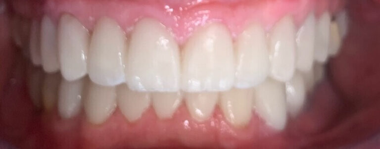 Dental Crown Patient in Shreveport, LA at Shreveport Dental Solutions