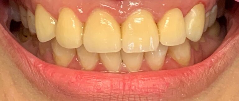 Dental Crown Patient in Shreveport, LA at Shreveport Dental Solutions