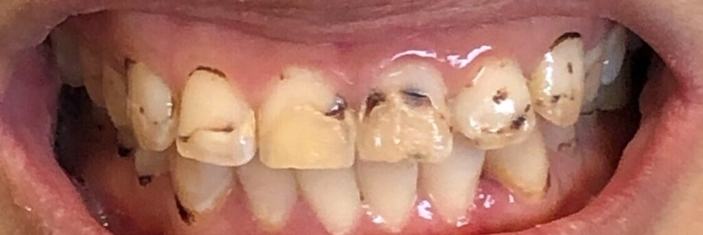 Dental Crown Patient in Shreveport, LA at Shreveport Dental Solutions