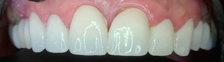 Dental Crown Patient in Shreveport, LA at Shreveport Dental Solutions