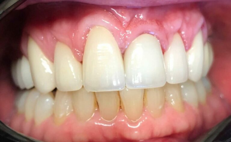 Dental Crown Patient in Shreveport, LA at Shreveport Dental Solutions
