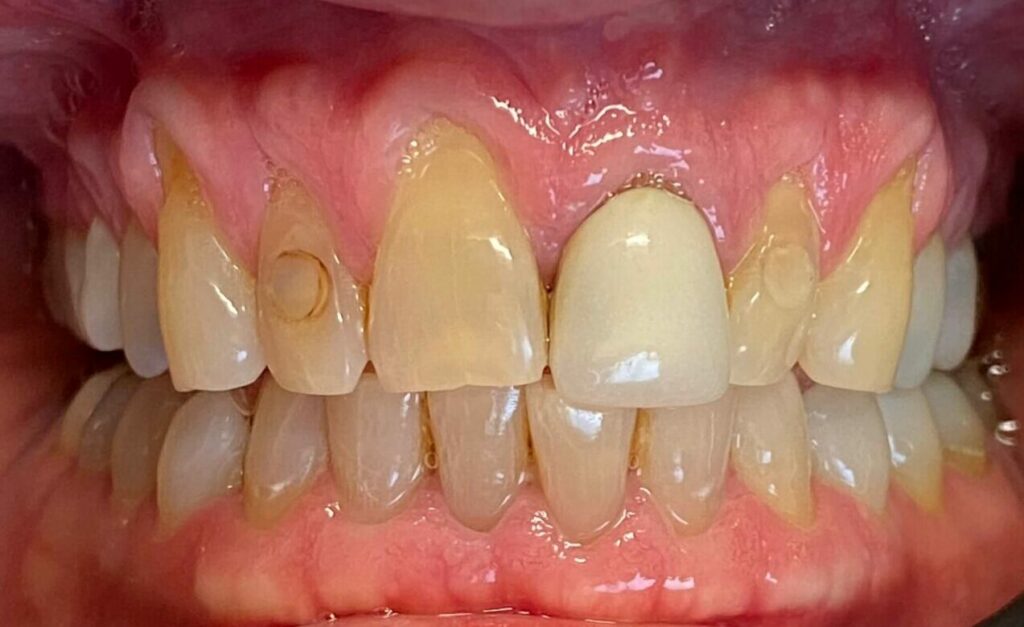 Dental Crown Patient in Shreveport, LA at Shreveport Dental Solutions