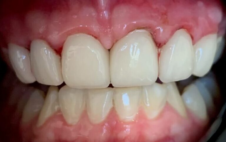 Dental Crown Patient in Shreveport, LA at Shreveport Dental Solutions